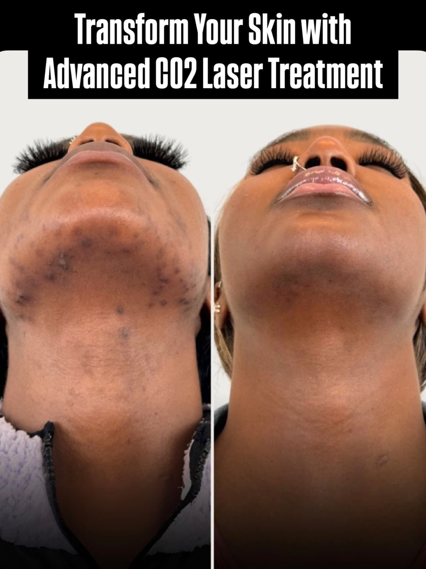 Professional DIAMOND TIP MICRODERMABRASION treatment at Age Reversal Clinics