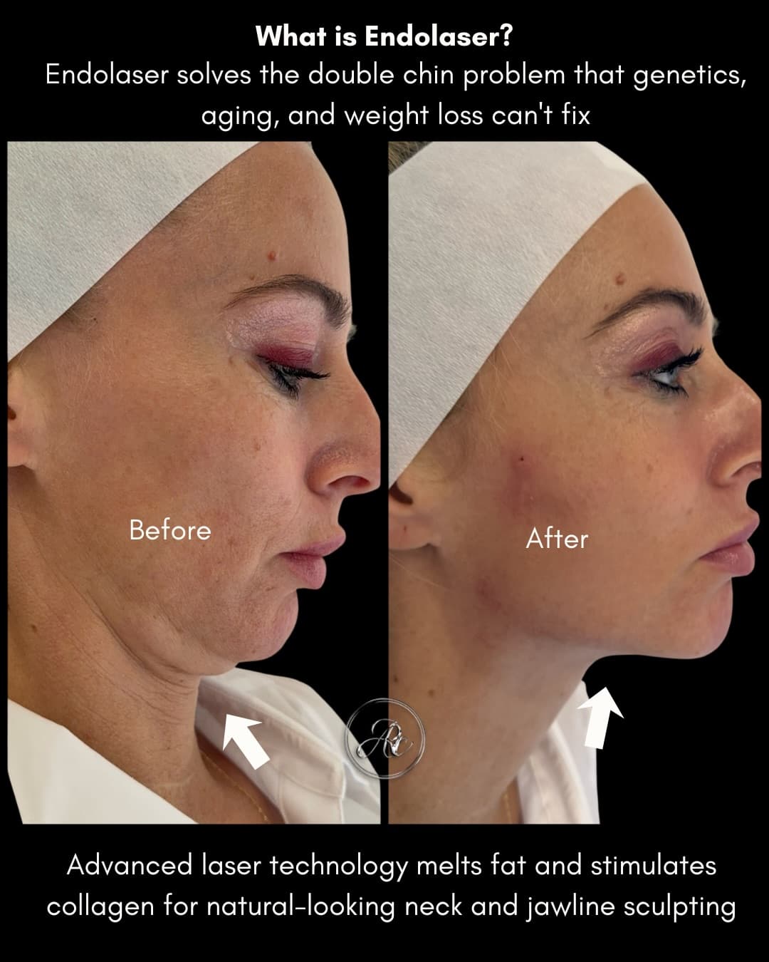 Professional AQUALYX AND DESO treatment at Age Reversal Clinics