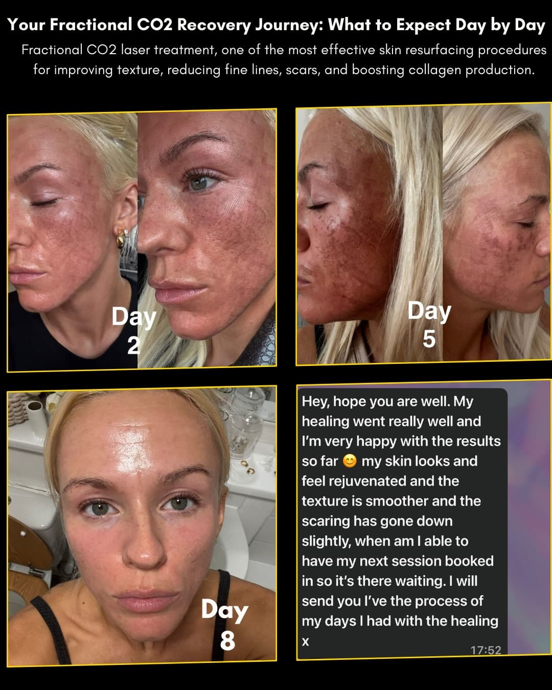 Professional EXTRACTIONS WITH SCRUBBER, STEAMER AND SUCTION treatment at Age Reversal Clinics