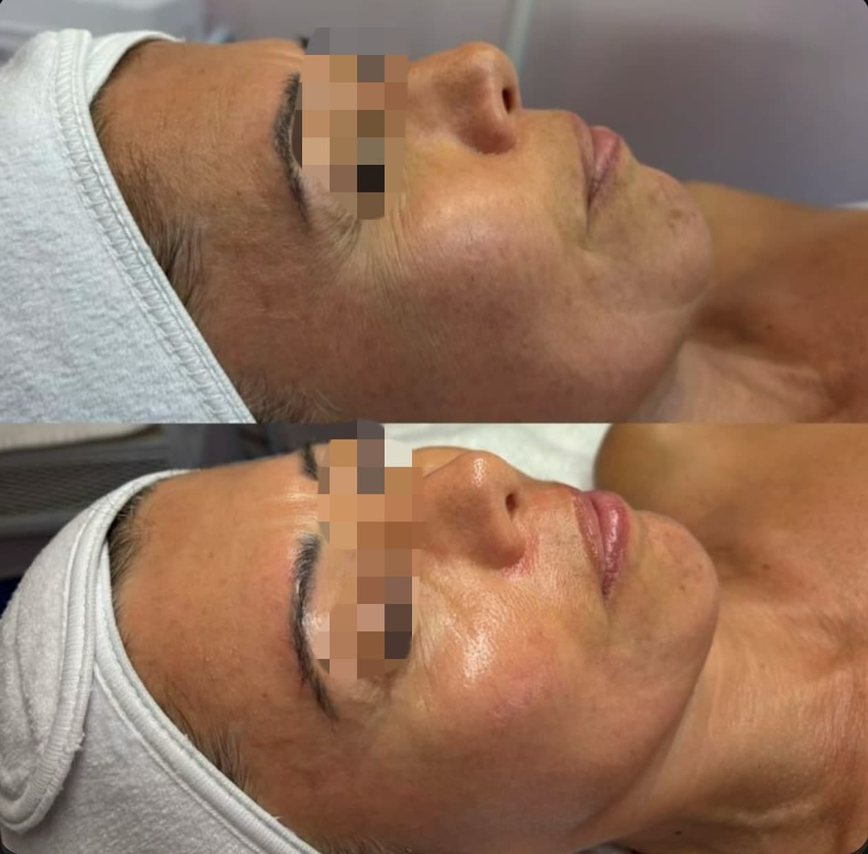 Professional NON-ABLATIVE FRACTIONAL LASER treatment at Age Reversal Clinics