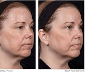 Professional RED CARPET FACIAL treatment at Age Reversal Clinics