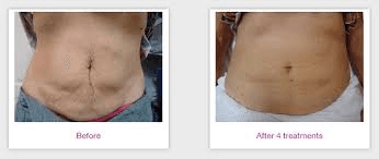 Professional VELASHAPE II treatment at Age Reversal Clinics